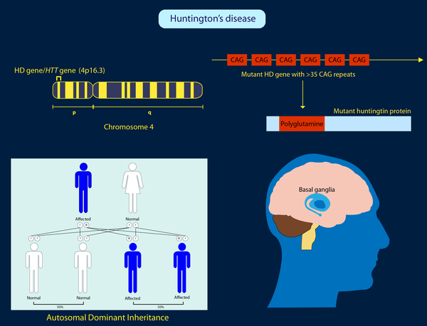 Cutting-edge new treatment for Huntington’s Disease